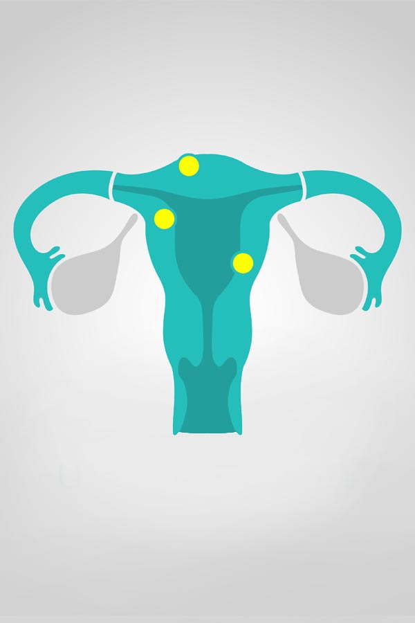 Fibroids-Treatment-East-Bay-Area-Audra-Foster Fibroids Treatment East Bay Area Audra Foster